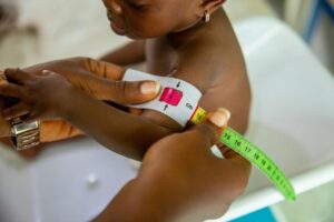 A health worker measures a child's mid-upper arm circumference (MUAC) using a color-coded tape to assess malnutrition. MUACメジャーテープで上腕周囲径を測定される乳児。A health worker measures a child's mid-upper arm circumference (MUAC) using a color-coded tape to assess malnutrition.